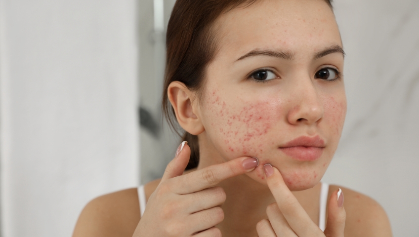 23dbe-acne-treatment-.jpg