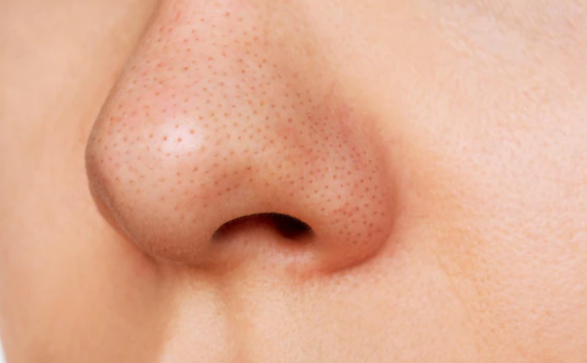 297ee-blackheads.png