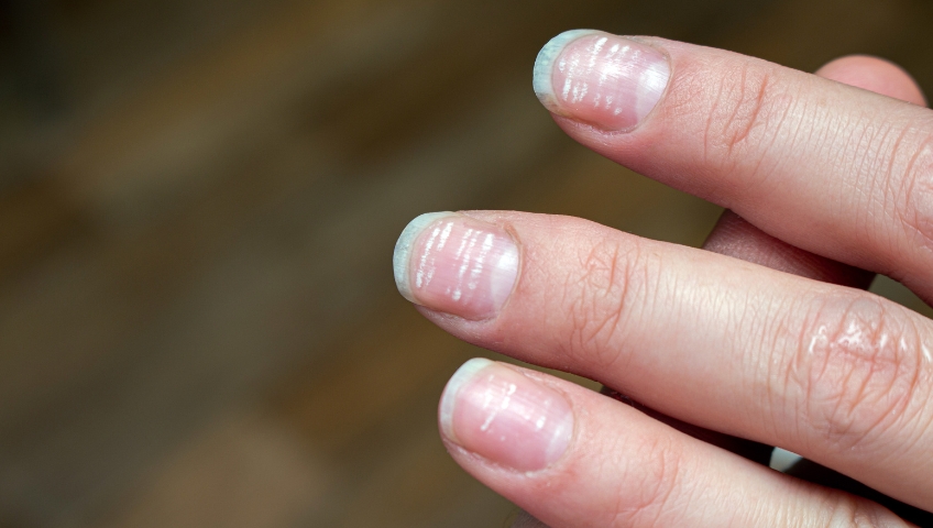 7c1df-white-spots-on-nails.jpg